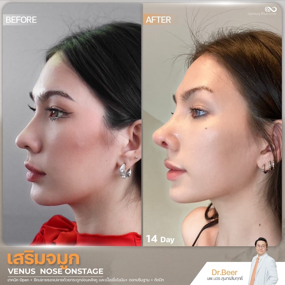 เสริมจมูก 1#1366