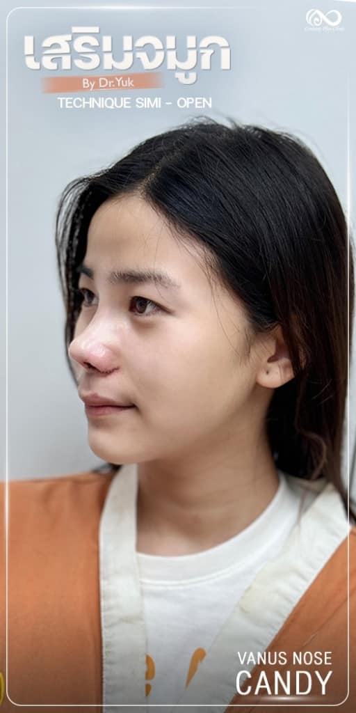 รีวิว เสริมจมูก #1317 , Century Clinic Thailand เสริมจมูก #1317
