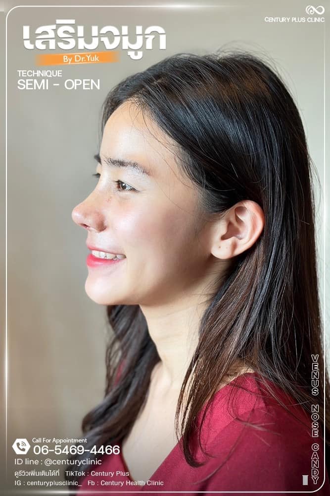 เสริมจมูก #1343