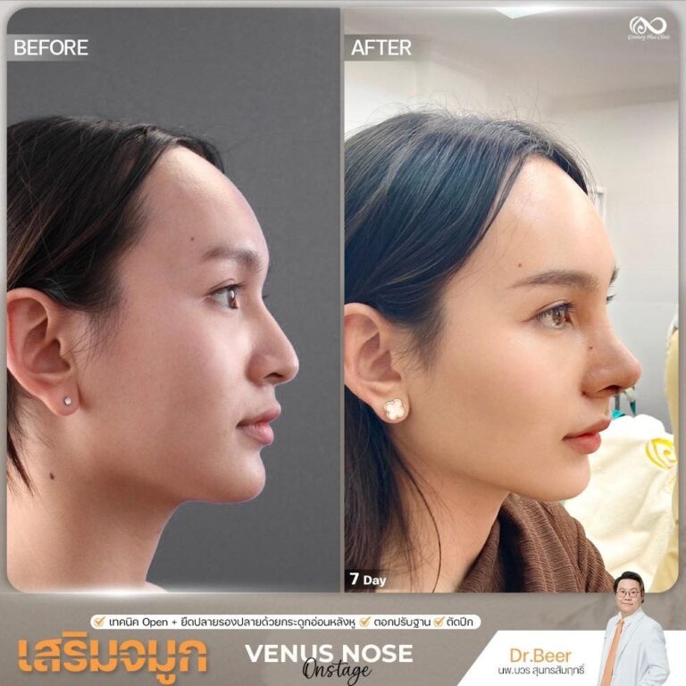 เสริมจมูก #1357