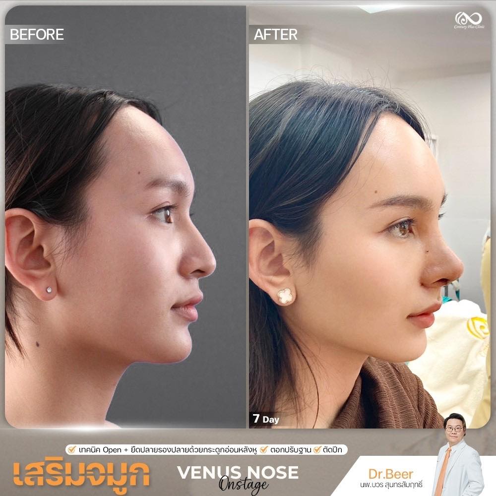 รีวิว เสริมจมูก #1357 , Century Clinic Thailand เสริมจมูก #1357