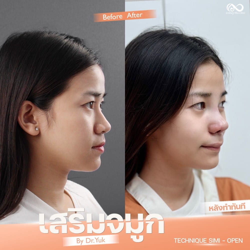 รีวิว เสริมจมูก #1317 , Century Clinic Thailand เสริมจมูก 2#1317