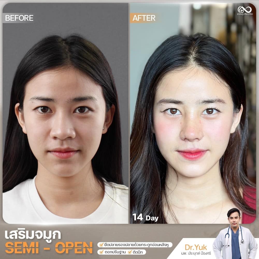 เสริมจมูก 2#1343