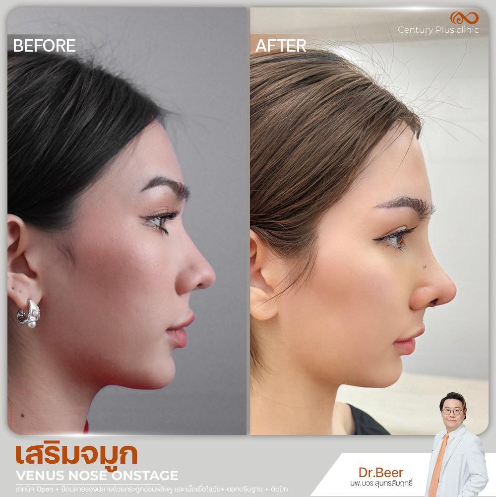 เสริมจมูก 2#1350
