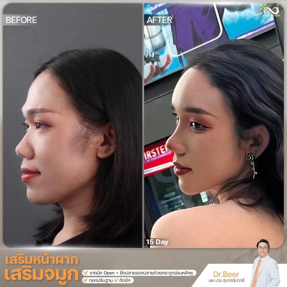 เสริมจมูก 2#1353