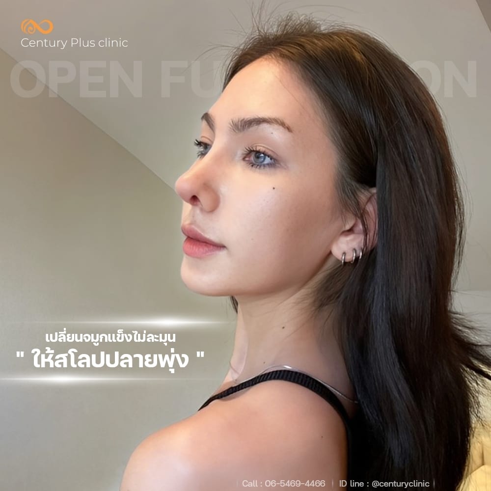 เสริมจมูก 2#1366