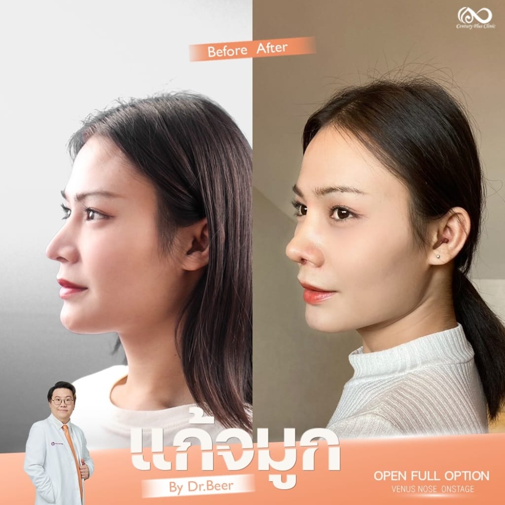 รีวิว แก้จมูก #1318 , Century Clinic Thailand แก้จมูก 1#1318