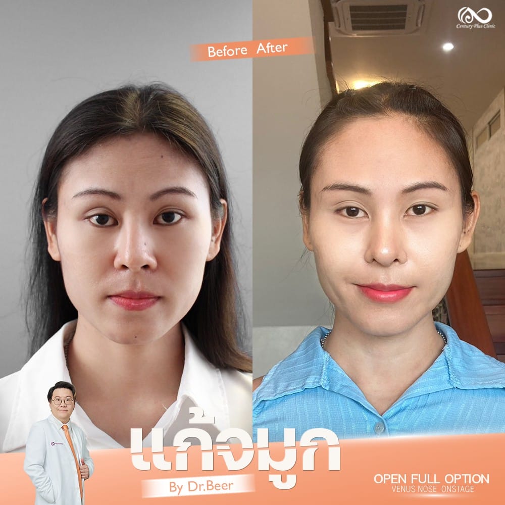 รีวิว แก้จมูก #1319 , Century Clinic Thailand แก้จมูก 1#1319