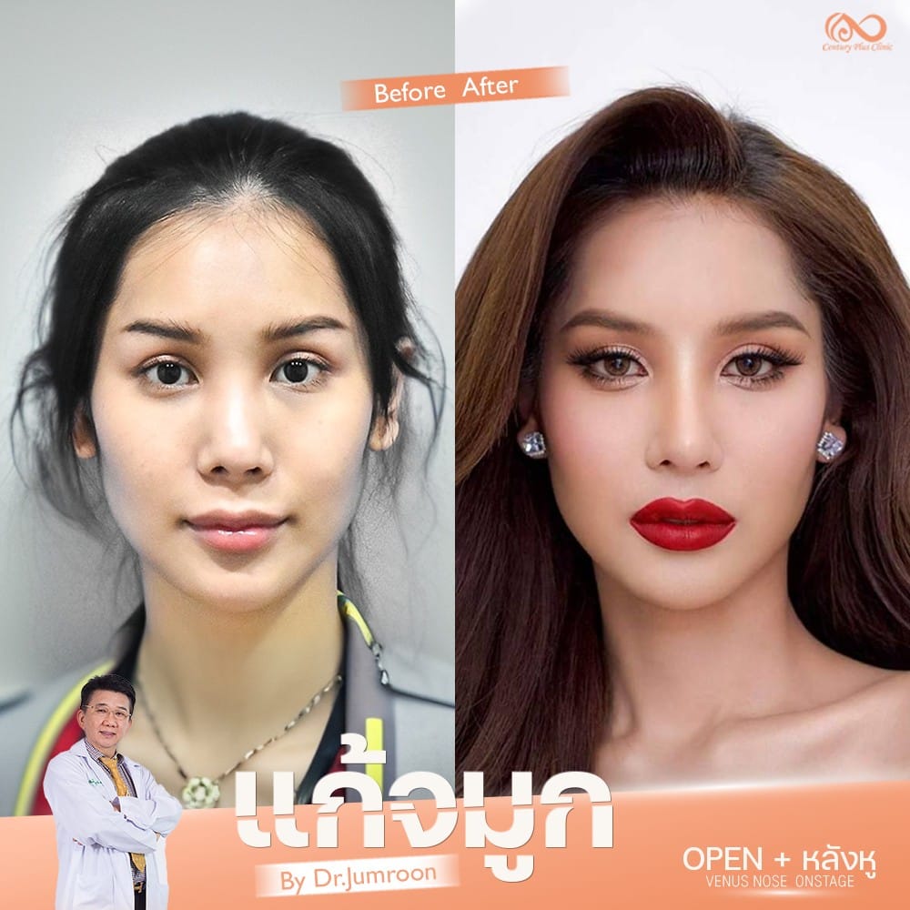 แก้จมูก 1#1322