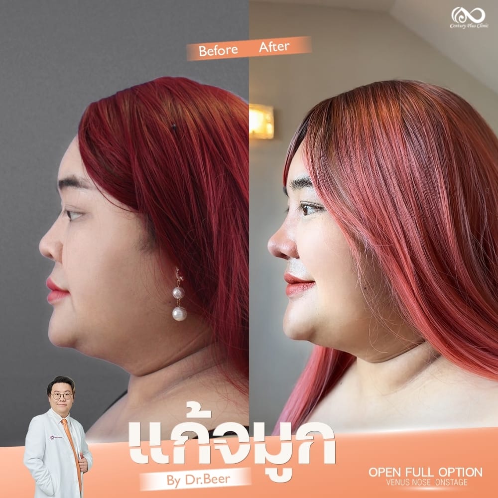 แก้จมูก 1#1324