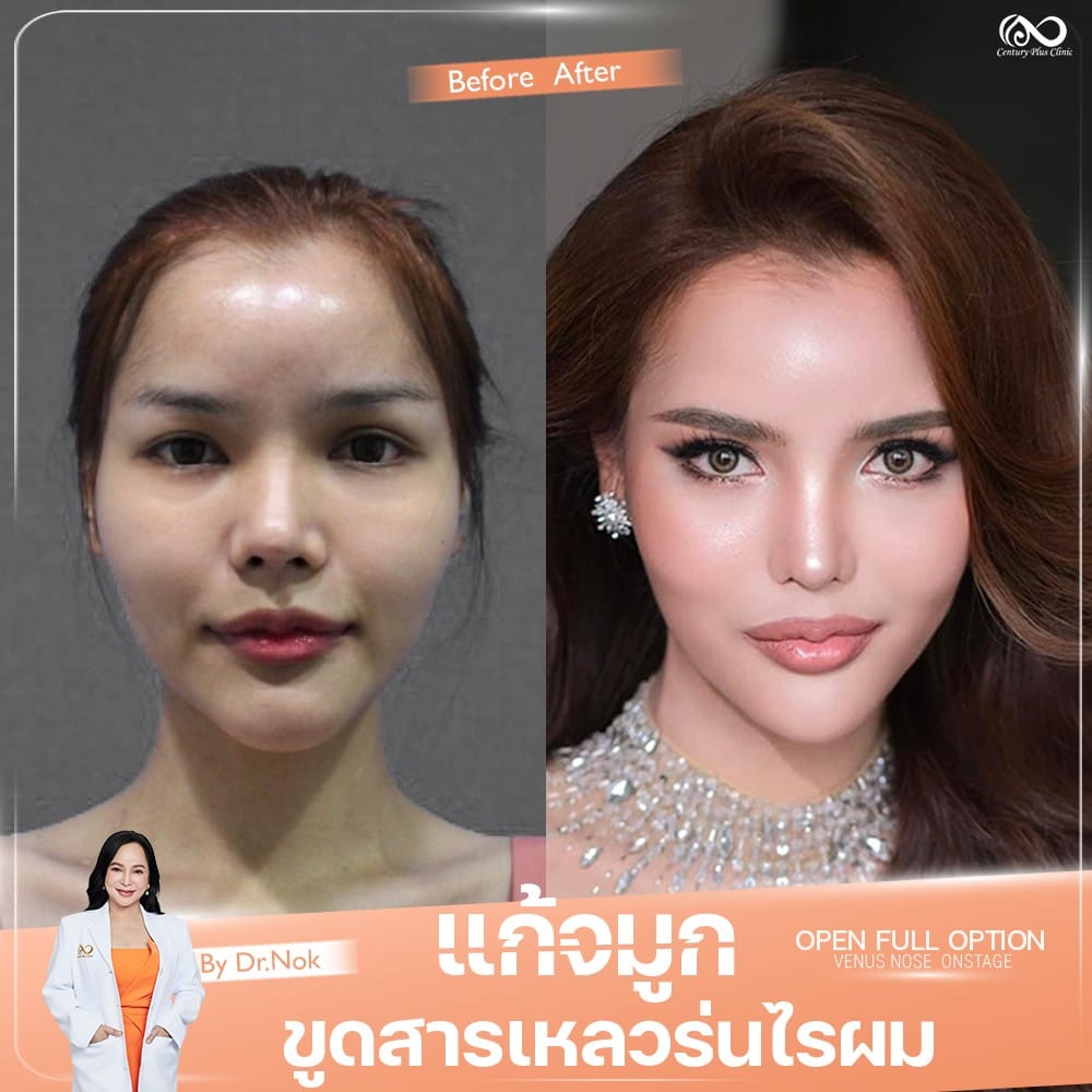 แก้จมูก 1#1334