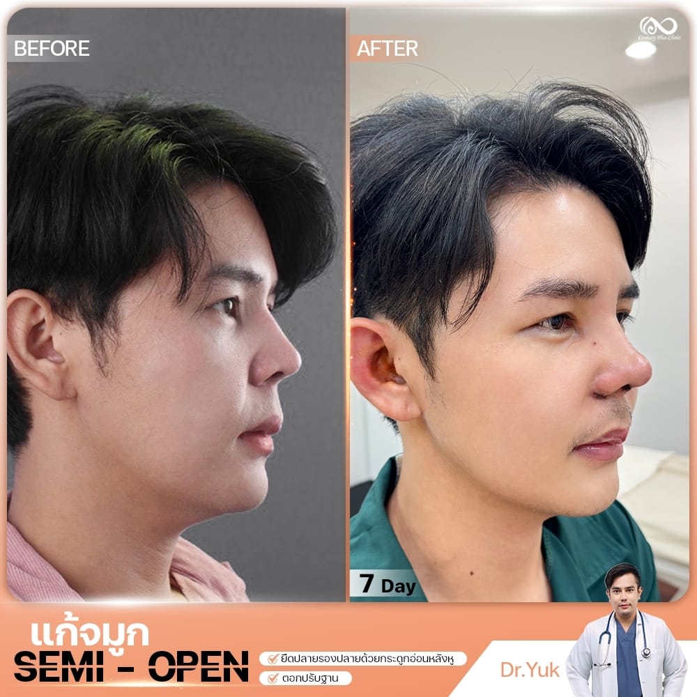 แก้จมูก 1#1342