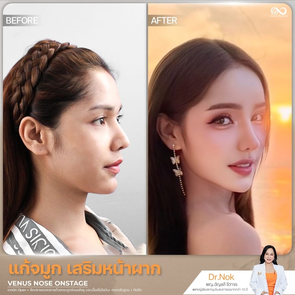 แก้จมูก 1#1351