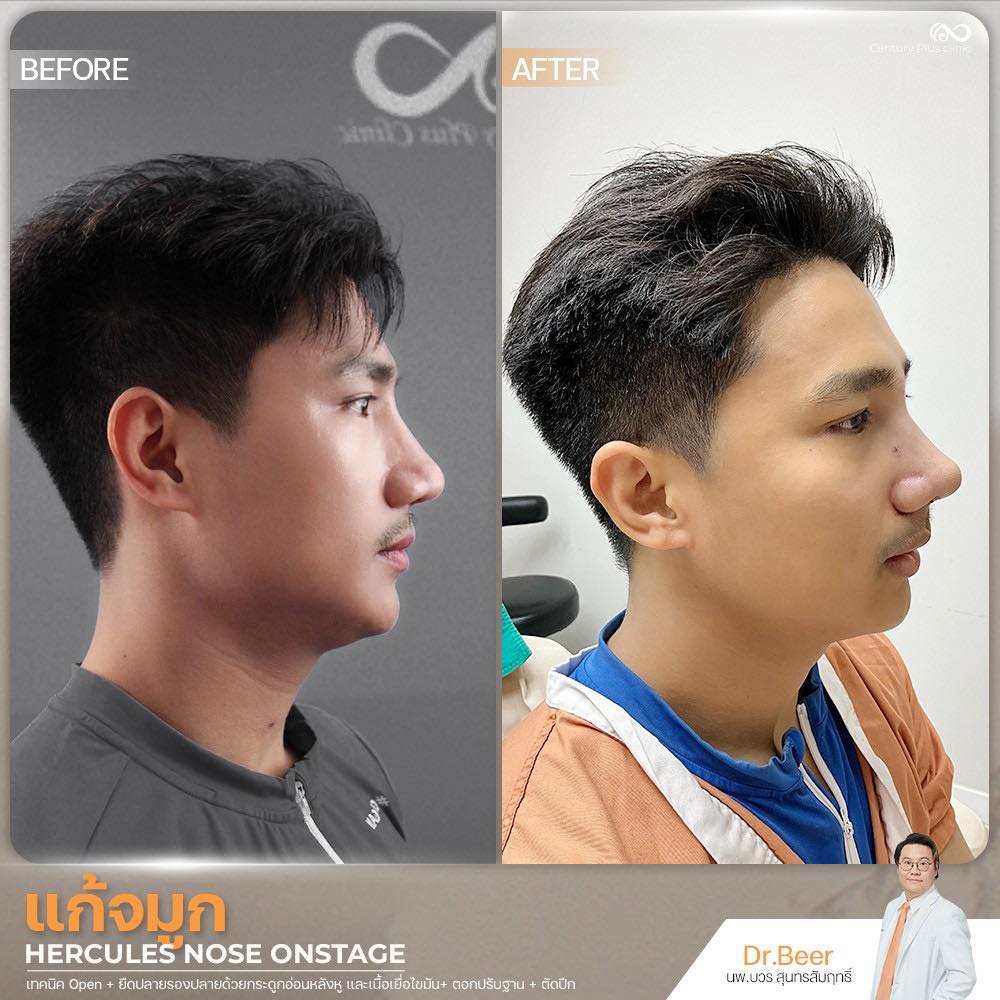 แก้จมูก 1#1367
