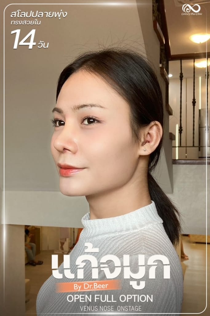 รีวิว แก้จมูก #1318 , Century Clinic Thailand แก้จมูก #1318