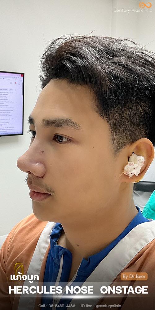 แก้จมูก #1367