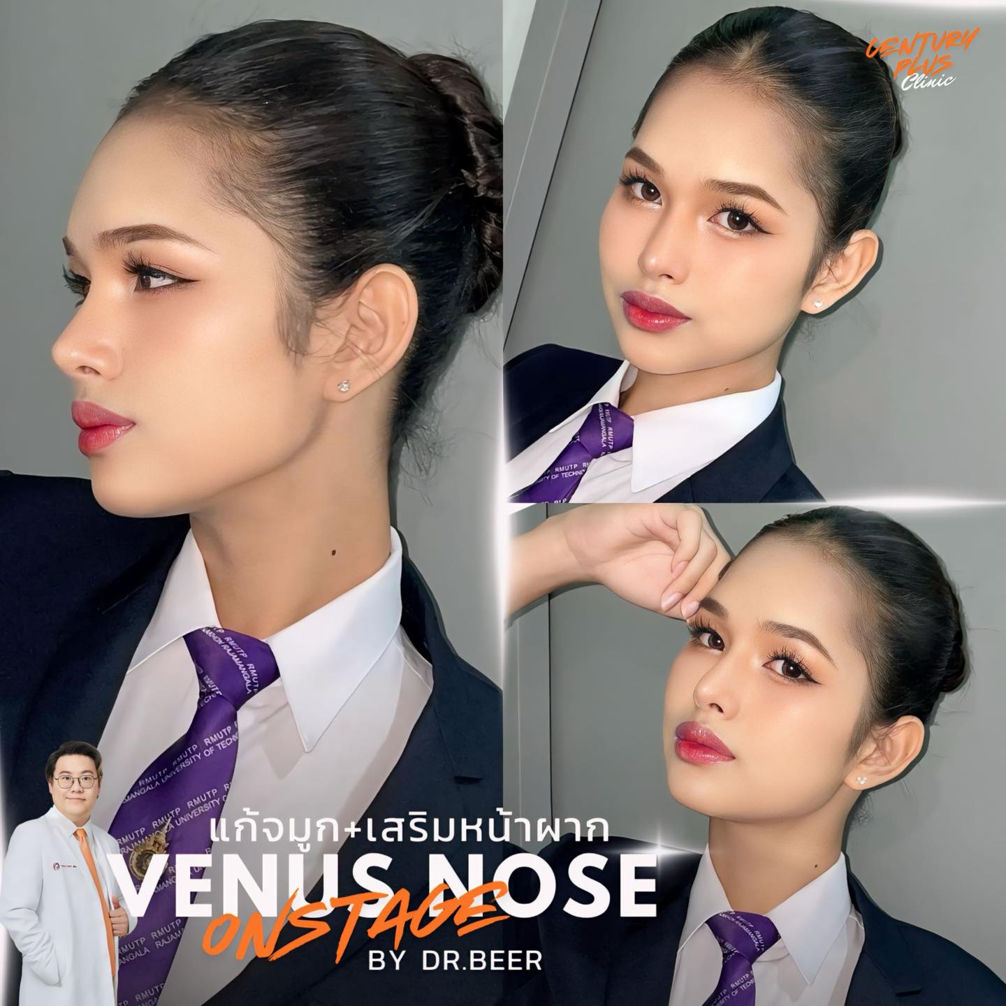 รีวิว แก้จมูก #1369 , Century Clinic Thailand แก้จมูก #1369
