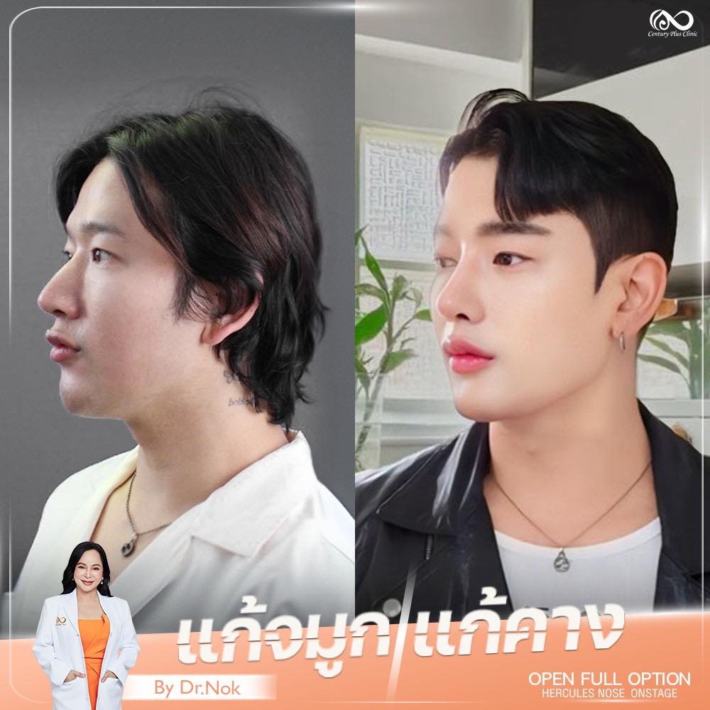 แก้จมูก 2#1312