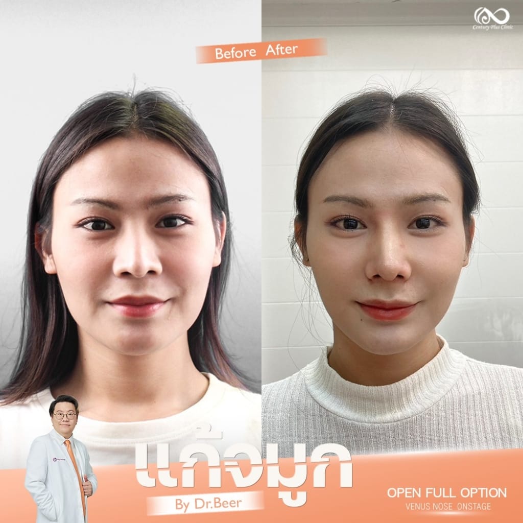 รีวิว แก้จมูก #1318 , Century Clinic Thailand แก้จมูก 2#1318