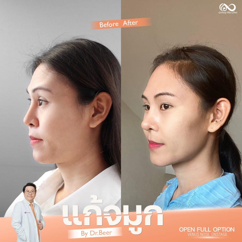 รีวิว แก้จมูก #1319 , Century Clinic Thailand แก้จมูก 2#1319