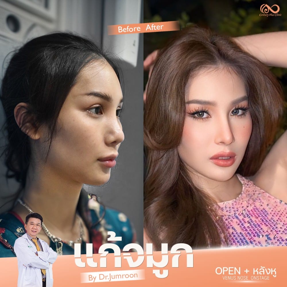 แก้จมูก 2#1322