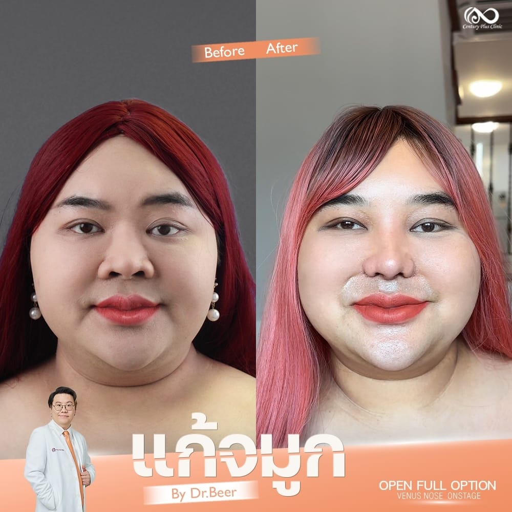 แก้จมูก 2#1324