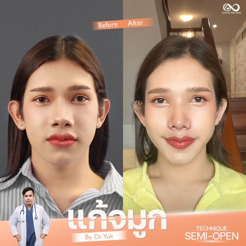รีวิว แก้จมูก #1336 , Century Clinic Thailand แก้จมูก 2#1336