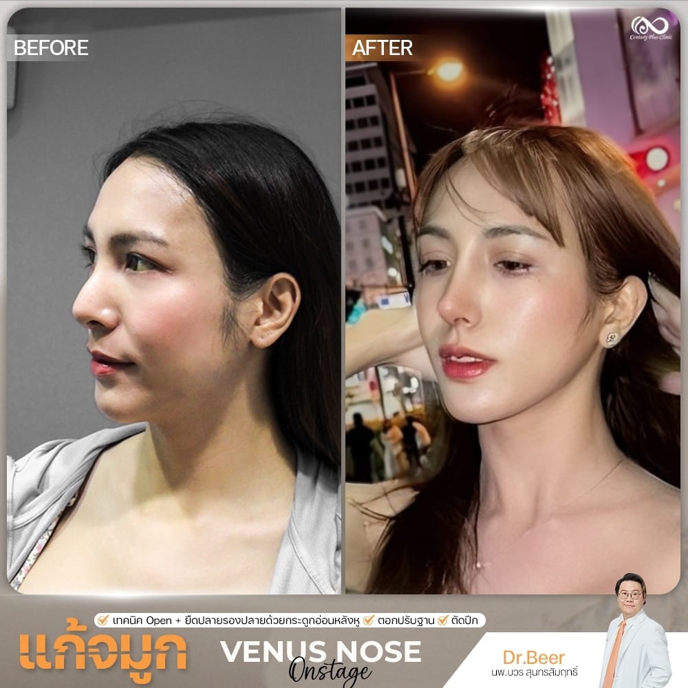 รีวิว แก้จมูก #1341 , Century Clinic Thailand แก้จมูก 2#1341