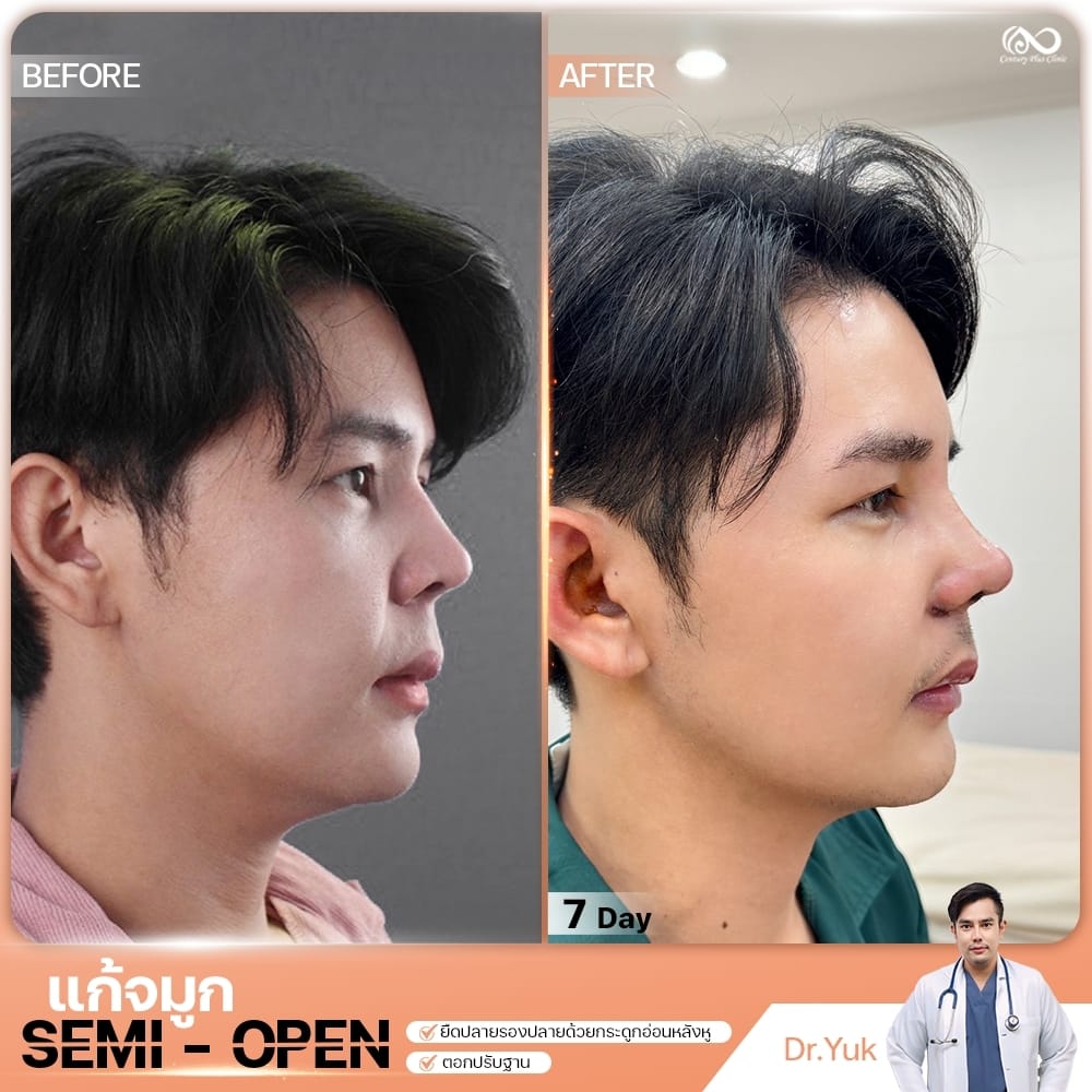 แก้จมูก 2#1342