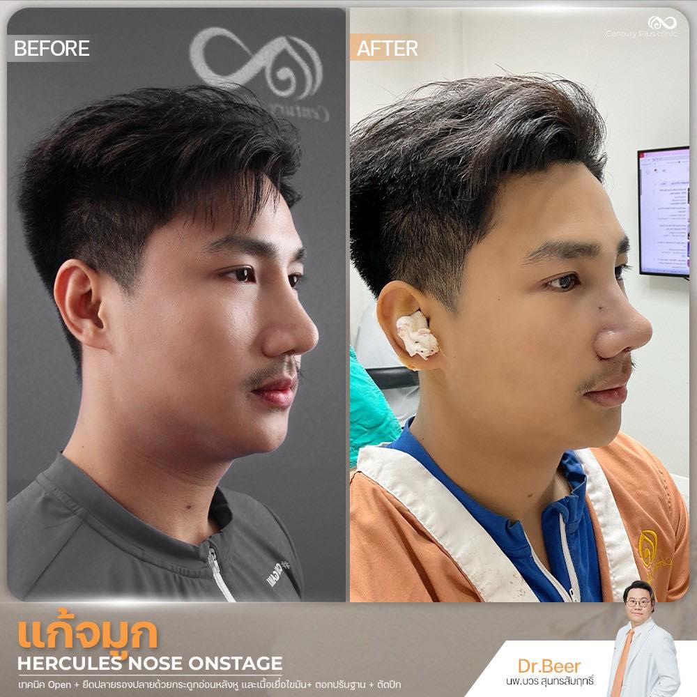 แก้จมูก 2#1367