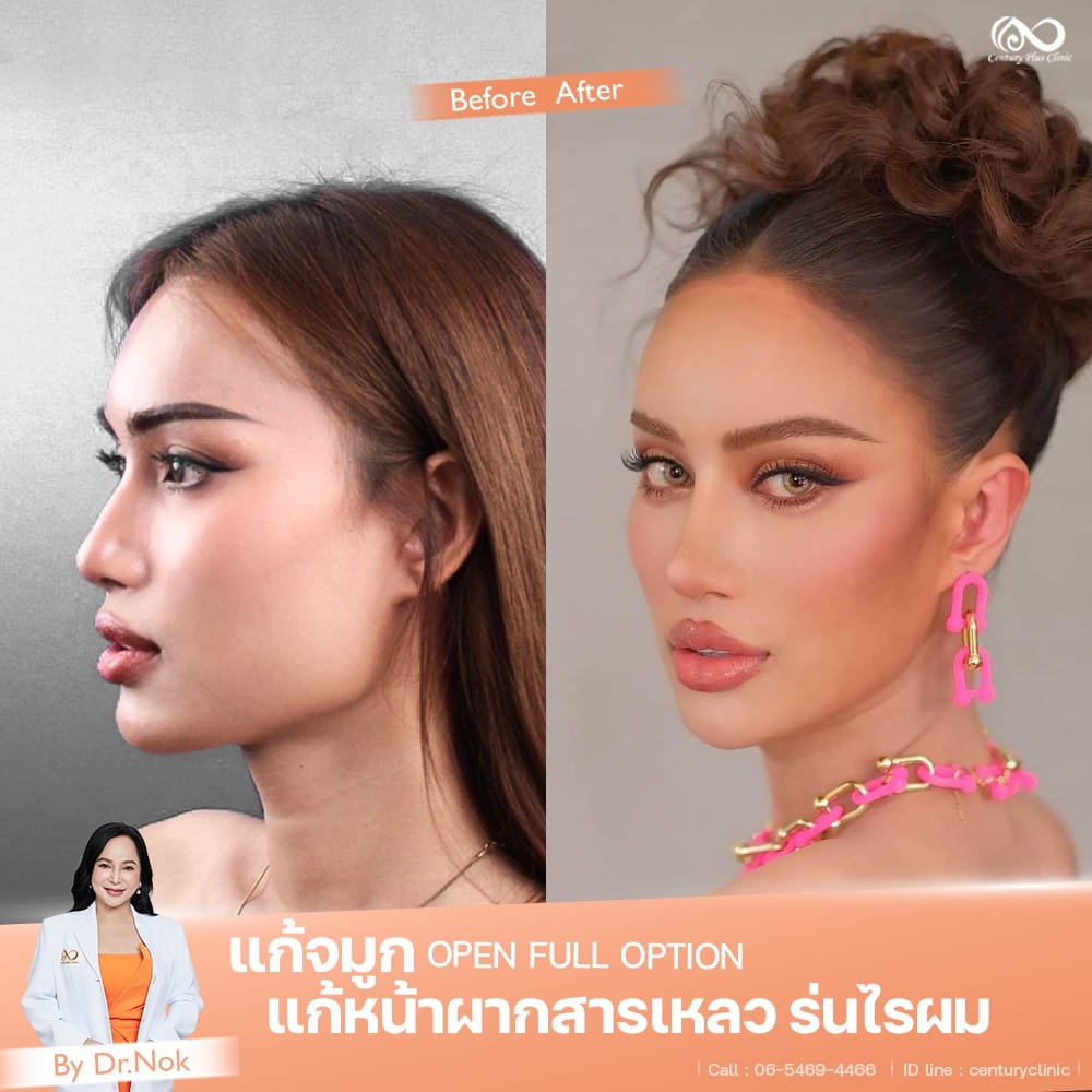 แก้จมูก1 #1316