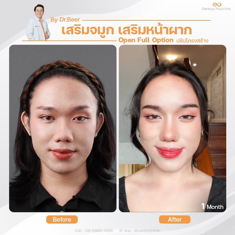 เสริมจมูก 1#1376