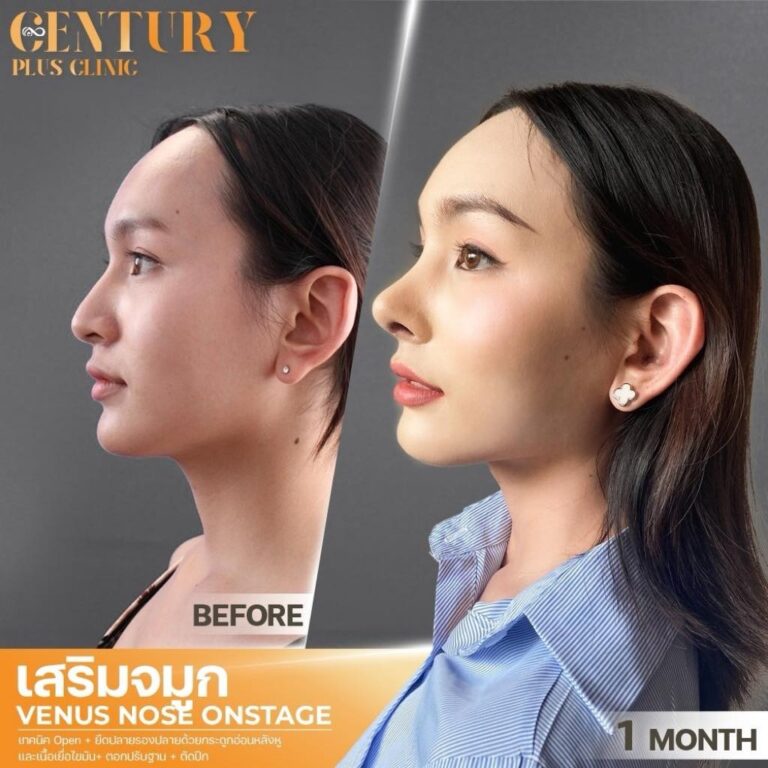 เสริมจมูก #1394
