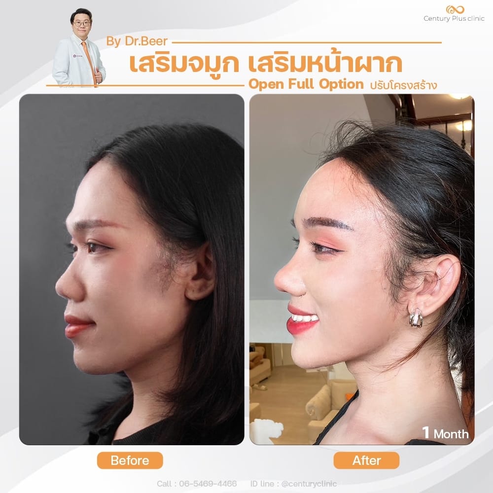 เสริมจมูก 2#1376