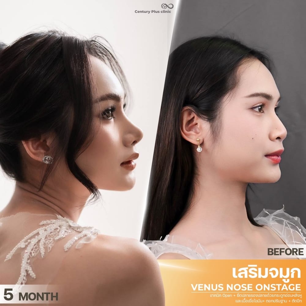 เสริมจมูก1 #1399