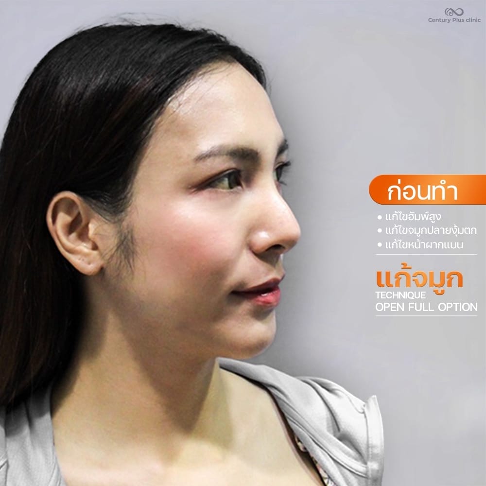 แก้จมูก 1#1385