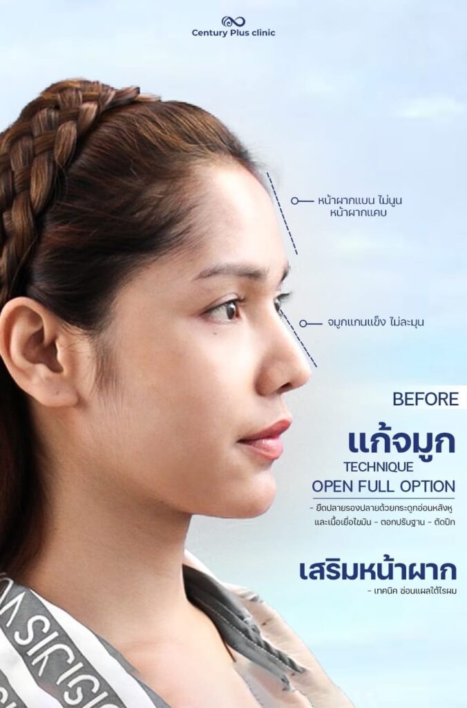 แก้จมูก 1#1392