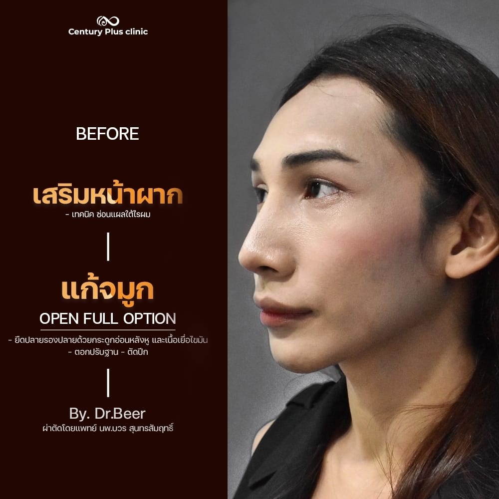 แก้จมูก 1#1401