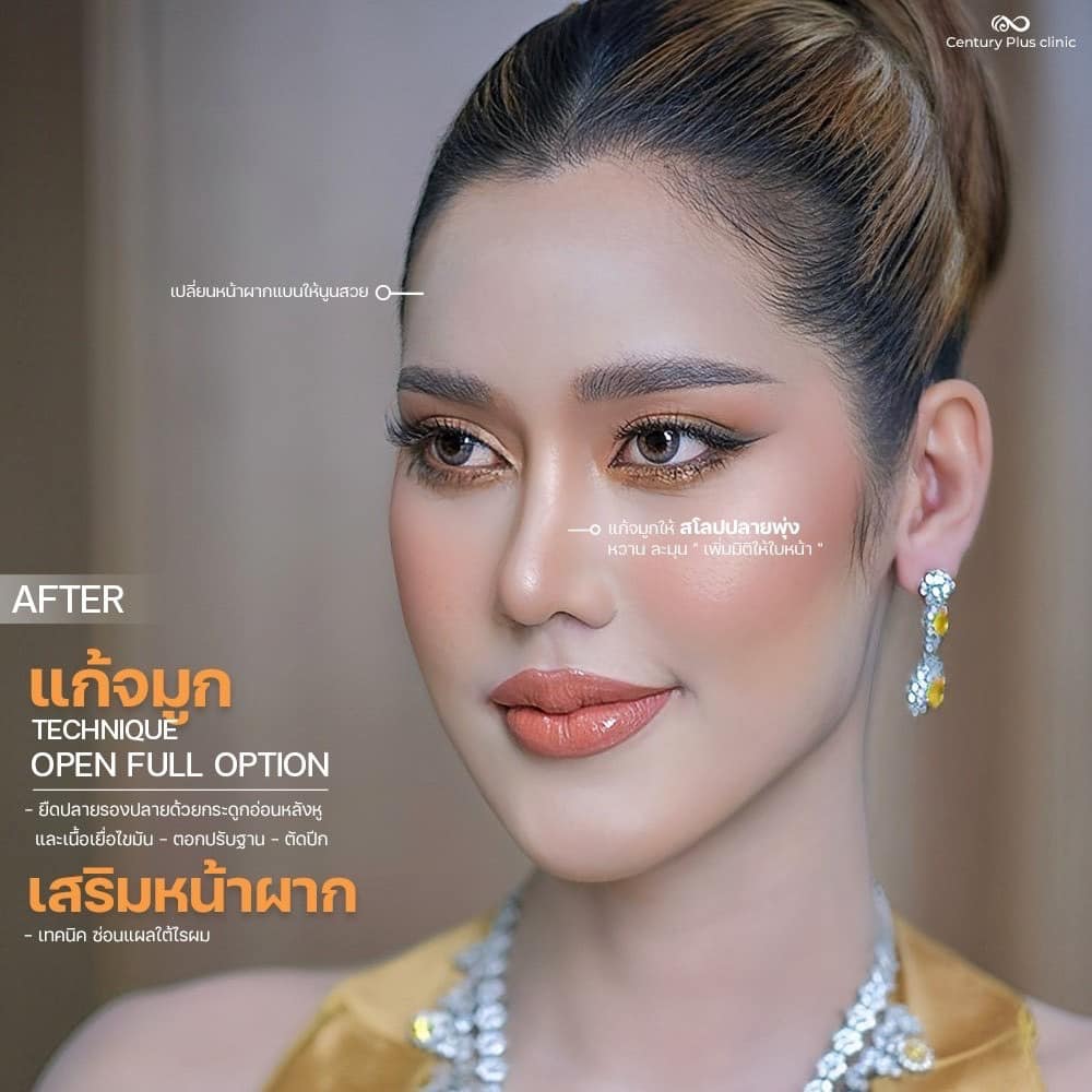 แก้จมูก 2#1391