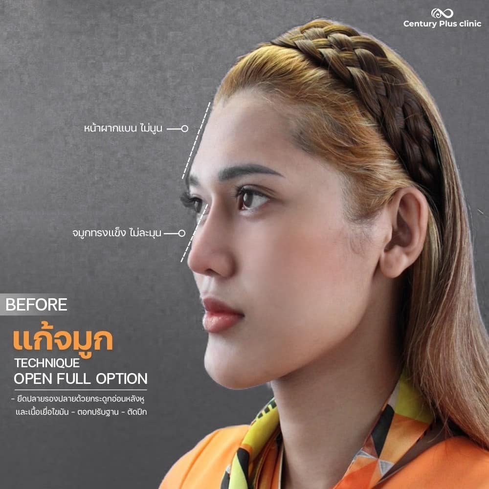 แก้จมูก1 #1391